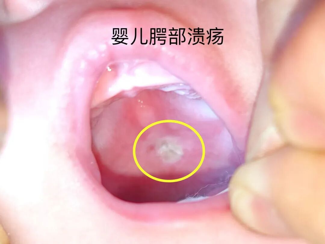 小小奶嘴暗藏隐患!青岛市妇女儿童医院提醒:避开喂养误区,守护宝宝喝奶时光