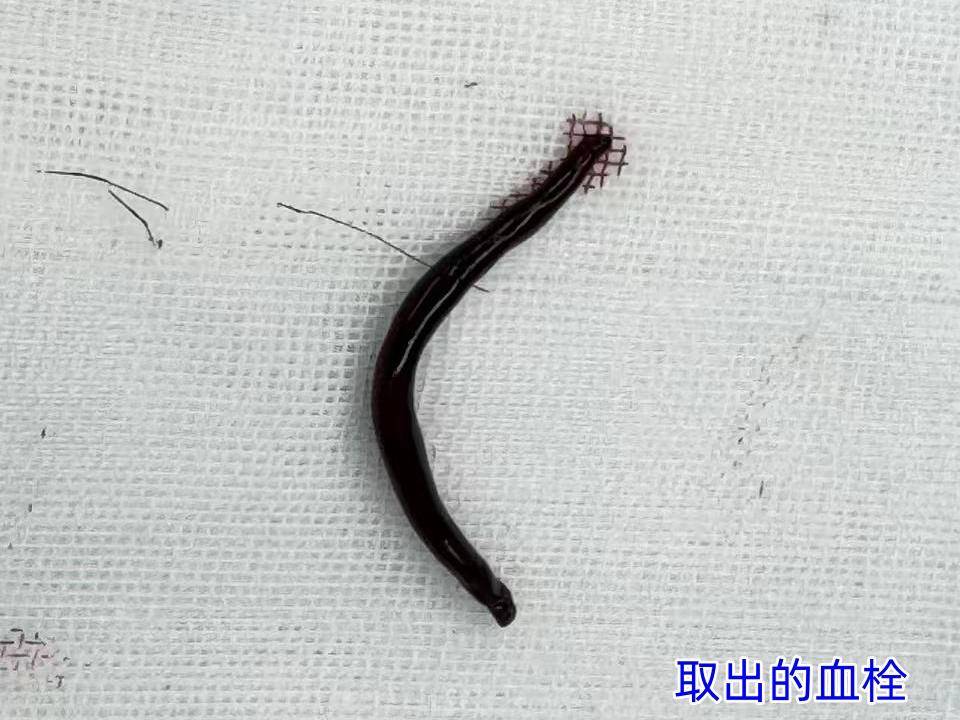 透析“生命线”突发闭塞,济南南郊医院肾内科团队紧急修补,成功打通生命通路