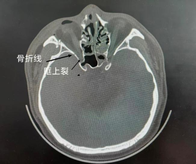 车祸伤后眼睛看不见,北大人民医院青岛医院紧急视神经减压术助青年重获光明