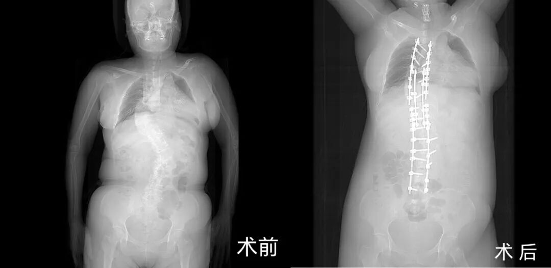 多阶段精细矫形护航生命|济南南郊医院成功救治重度先天性脊柱侧弯伴颈椎病变患者