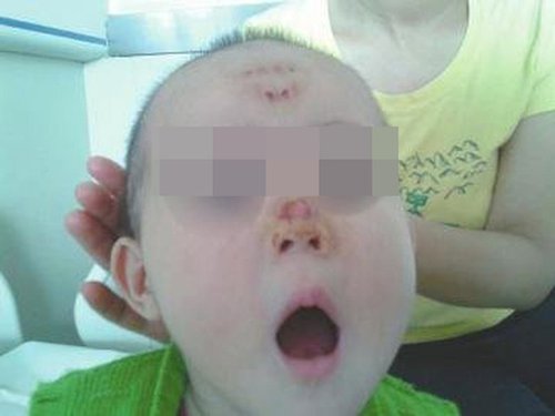 四川2岁儿童被同学连咬9口 鼻子最严重会留疤