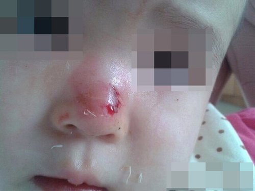 四川2岁儿童被同学连咬9口 鼻子最严重会留疤