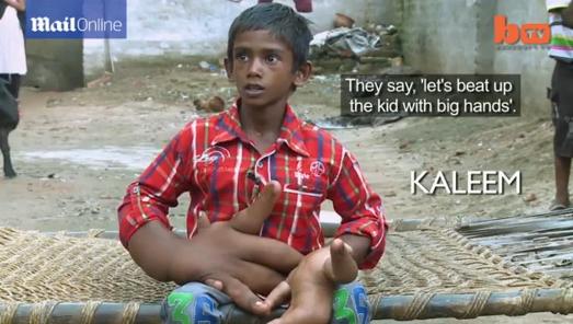 印度8岁男孩患病长出巨人手掌每只手大如头（图）