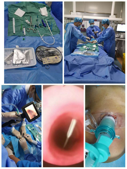 气胸胸腔镜手术过程图片
