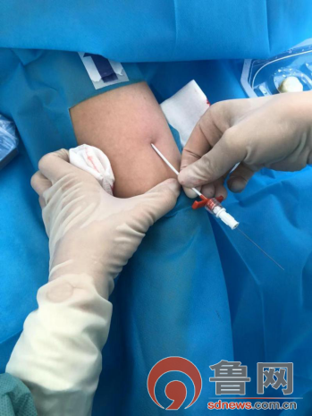 菏泽牡丹区小留镇中心卫生院成功置入中线导管提升静脉输液护理质量