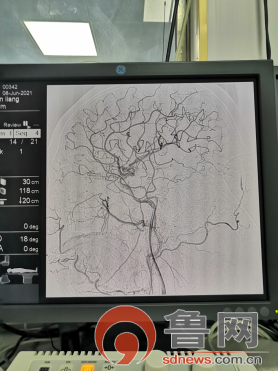 菏澤市牡丹區中醫醫院成功開展首例全腦血管造影術