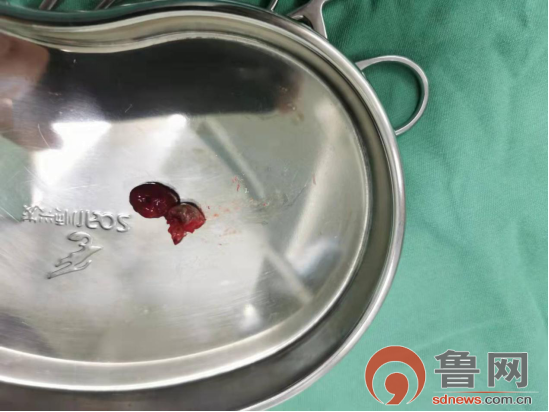 菏泽市立医院为巨大声带息肉困难气道患者顺利切除息肉