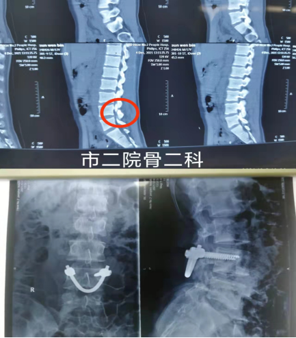 菏澤市二院骨科採用u形棒固定系統單節段固定與峽部植骨治療青少年