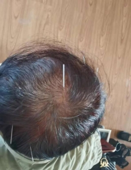 踔厉奋进】泰安市中医医院特色疗法系列报道——龙砂开阖六气针法