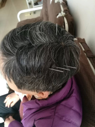 踔厉奋进】泰安市中医医院特色疗法系列报道——龙砂开阖六气针法