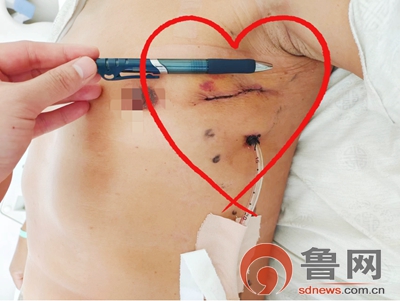 首例薛城区人民医院成功开展胸腔镜下胸腺瘤微创切除术