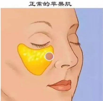 苹果肌功效_怎么去苹果肌_祛除苹果肌