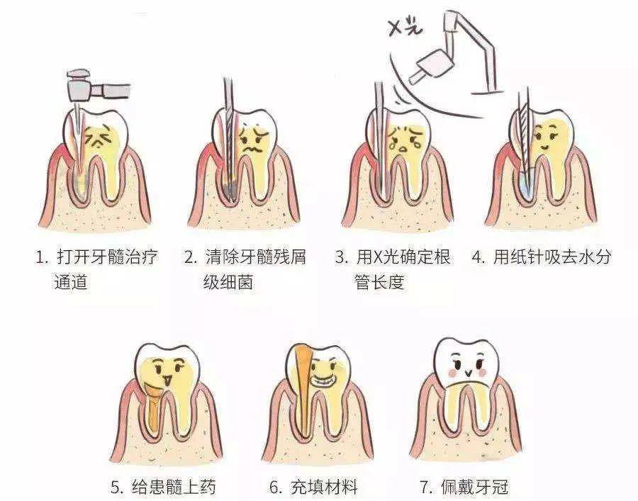 抽牙髓过程图解图片