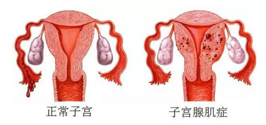 肚子变大不一定是怀孕