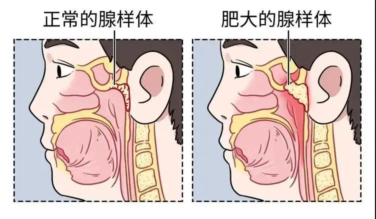 儿童腺样体肥大怎么治疗比较好?