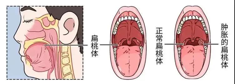 腺样体肥大位置图片