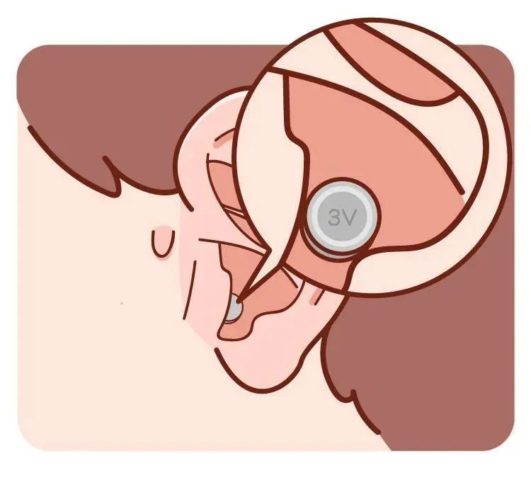 异物跑到耳朵内怎么办成都民生耳鼻喉医院教你外耳道异物的正确处理