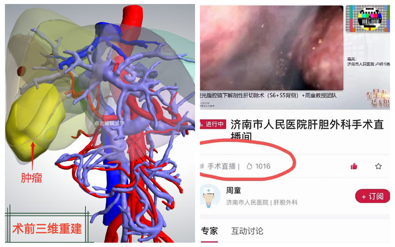 济南市人民医院肝胆血管外科成功举行手术直播学术活动