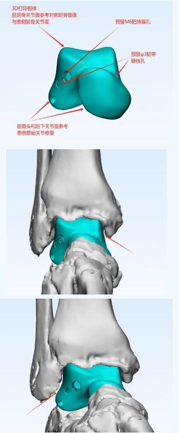 临沂市首例！一走路就脚疼？“打印”一块骨头装进脚踝