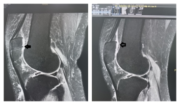 自体血液变身“修复液”：PRP技术为组织再生提供新选择