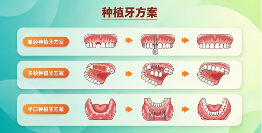 种植牙方案