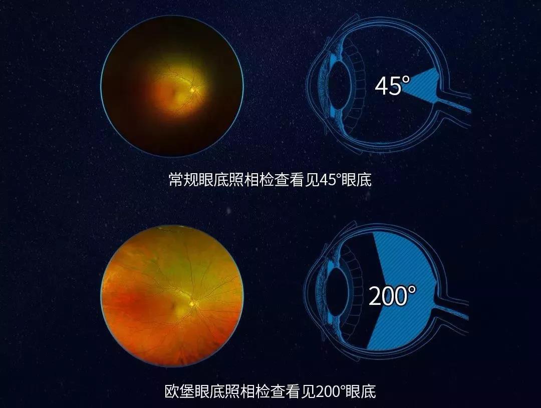 泰安光明爱尔眼科医院爱眼日科普眼底一张照眼病早知道