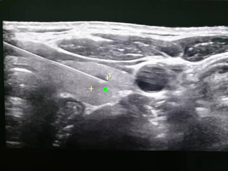 保甲无痕护甲有方泰安市中医医院超声介入科开展甲状腺结节微创消融术