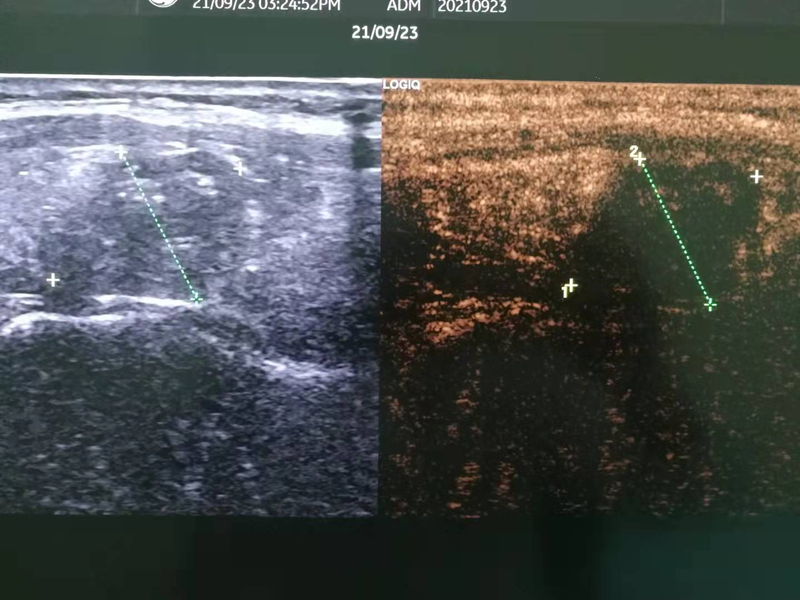 保甲无痕,护甲有方 泰安市中医医院超声介入科开展甲状腺结节微创消融