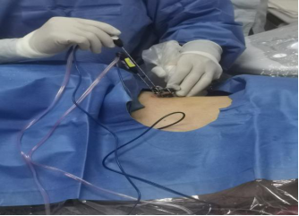 融会贯通泰安市中医医院成功完成一例超声引导下肝转移瘤射频消融术