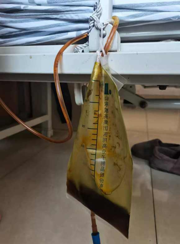 泰安市中医医院超声介入科成功完成一例高难度胆道引流术