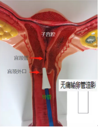 输卵管造影过程图图片
